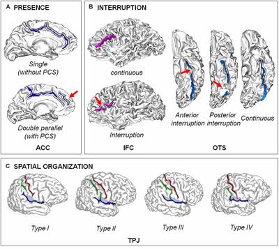 Towards Deciphering the Fetal Foundation of Normal Cognition and Cognitive Symptoms From Sulcation of the Cortex